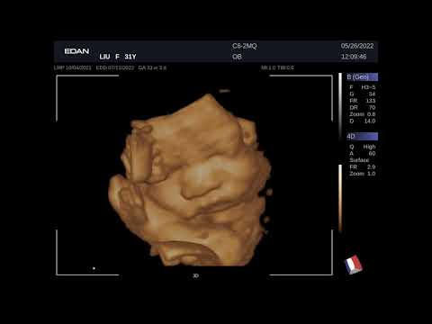 Кинопетли Edan Acclarix LX9 Акушерство