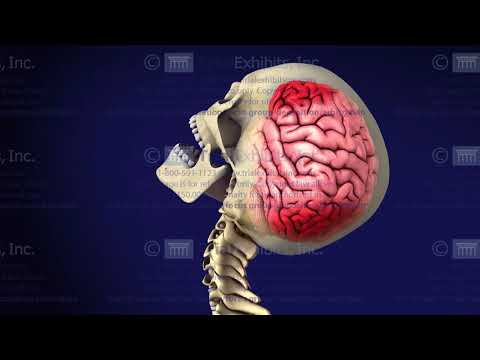 Coup-Contrecoup Injury Medical Exhibit