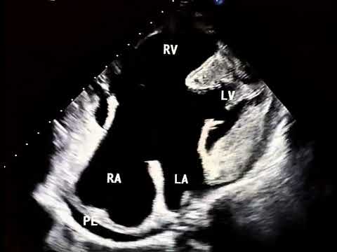 Atrioventricular Septal Defect (AVSD): Is It Restricted to Infancy?