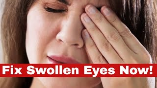Life-Changing Hacks: How to Get Rid of Swollen Eyes FAST!
