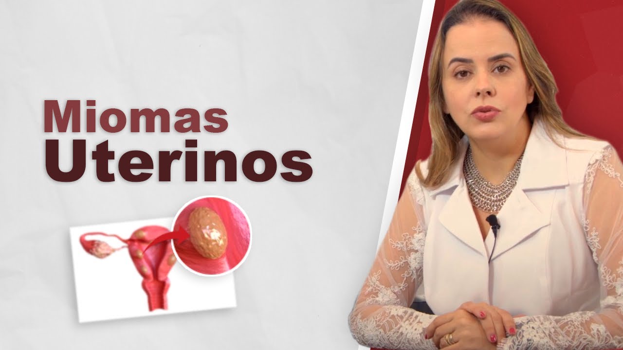 Miomas uterinos. Leiomiomas no útero. Mal muito frequente.