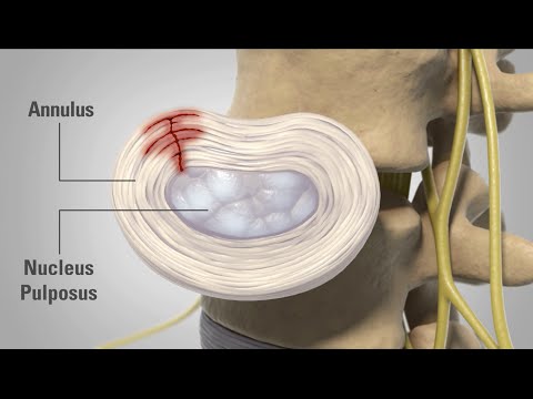 Wunder Hals, als ob erstickt Das ist für Osteochondrose und Hernien der Halswirbelsäule vorgeschriebenen