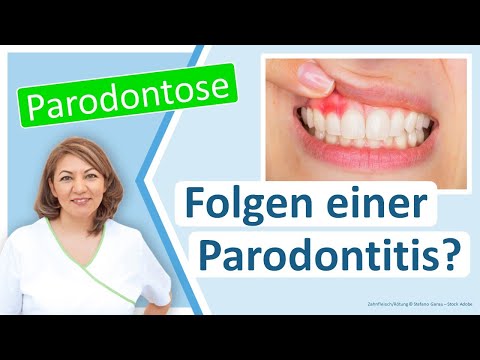 Zahnfleisch-Entzündung: Was sind die Folgen einer Parodontitis? Zahnarztpraxis Großostheim N. Redjai