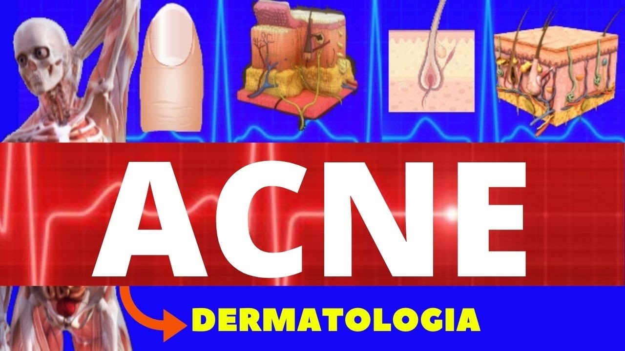 ACNE (CAUSAS, TIPOS, E TRATAMENTO) - COMO TRATAR ACNE (TUDO SOBRE ACNE)
