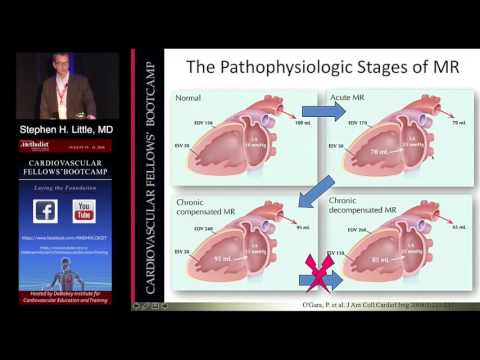 Mitral Regurgitation (Stephen H. Little, MD) Sunday, August 21, 2016