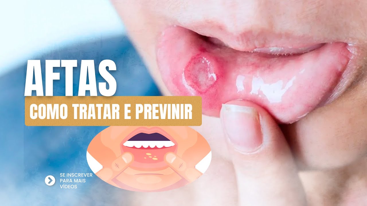 Como Tratar e Prevenir Aftas: Dicas Simples e Eficazes