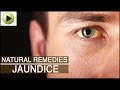 Jaundice - Natural Ayurvedic Home Remedies