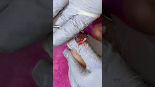 Ep_8791 Big ingrown toenail removal 👣 ตัดเล็บ..สั้นเกินไปมีผลอะไรคะ 😅 (clip from Thailand)