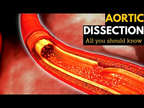 Myocardial Infarction Causes Signs and Symptoms Diagnosis and Treatment