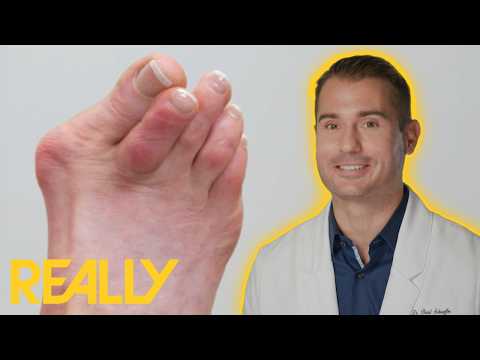 Dr. Brad Revisits The Worst Case Of Dancer’s Feet He’s Ever Seen | My Feet Are Killing Me
