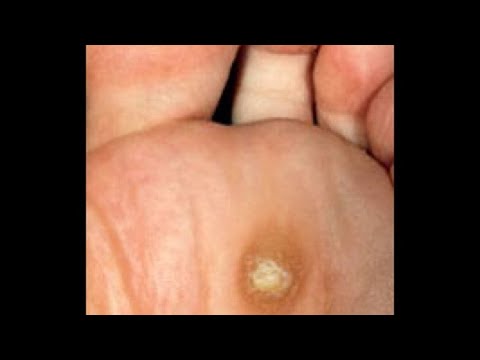 Vestibular papillomatosis causes