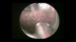 Στένωμα ουρήθρας μετά από τοποθέτηση καθετήρα