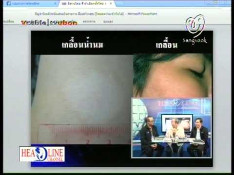 Oktenisept และโรคสะเก็ดเงิน โรคสะเก็ดเงินบนผลกระทบฟุต