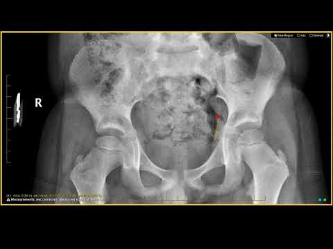 Legg-Calvé-Perthes disease on X-Ray - Cartilage Injuries & Abnormalities