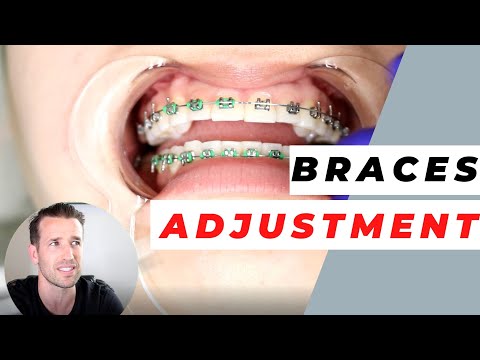 Orthodontist Explains Monthly Adjustments | Monthly Visits