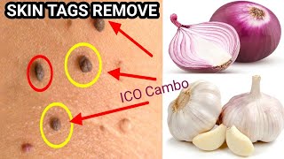 REMOVE SKIN TAGS OVERNIGHT WITH RED ONION & TOOTHPASTE || HOW TO GET RID OF SKIN TAGS  || ICO cambo