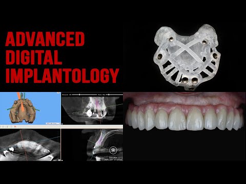 All on four - Msoft - Intraoral welding - Lego bridge - Prosthetic oriented guided surgery