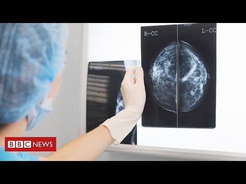 癌症患者在冠狀病毒大流行期間看專科醫生的人數大幅下降 - BBC News (Huge fall in cancer patients seeing specialists during coronavirus pandemic  - BBC News)