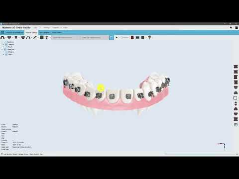 Pose des brackets | Découpe et Fermeture | Exportation du modèle avec brackets