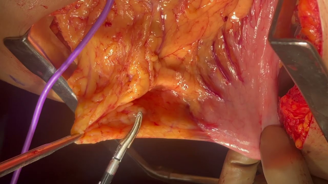 Surgical video by Dr. Rajesh Mistry