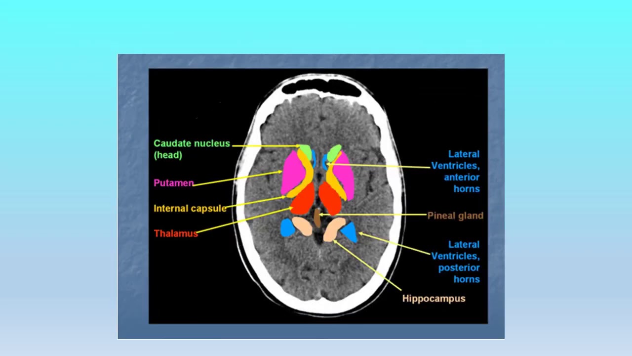 CT Brain Dr Amira HAmed Darwish 2020