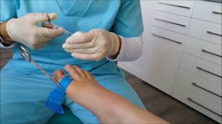 Espiculaectomía bajo anestesia troncular del primer dedo