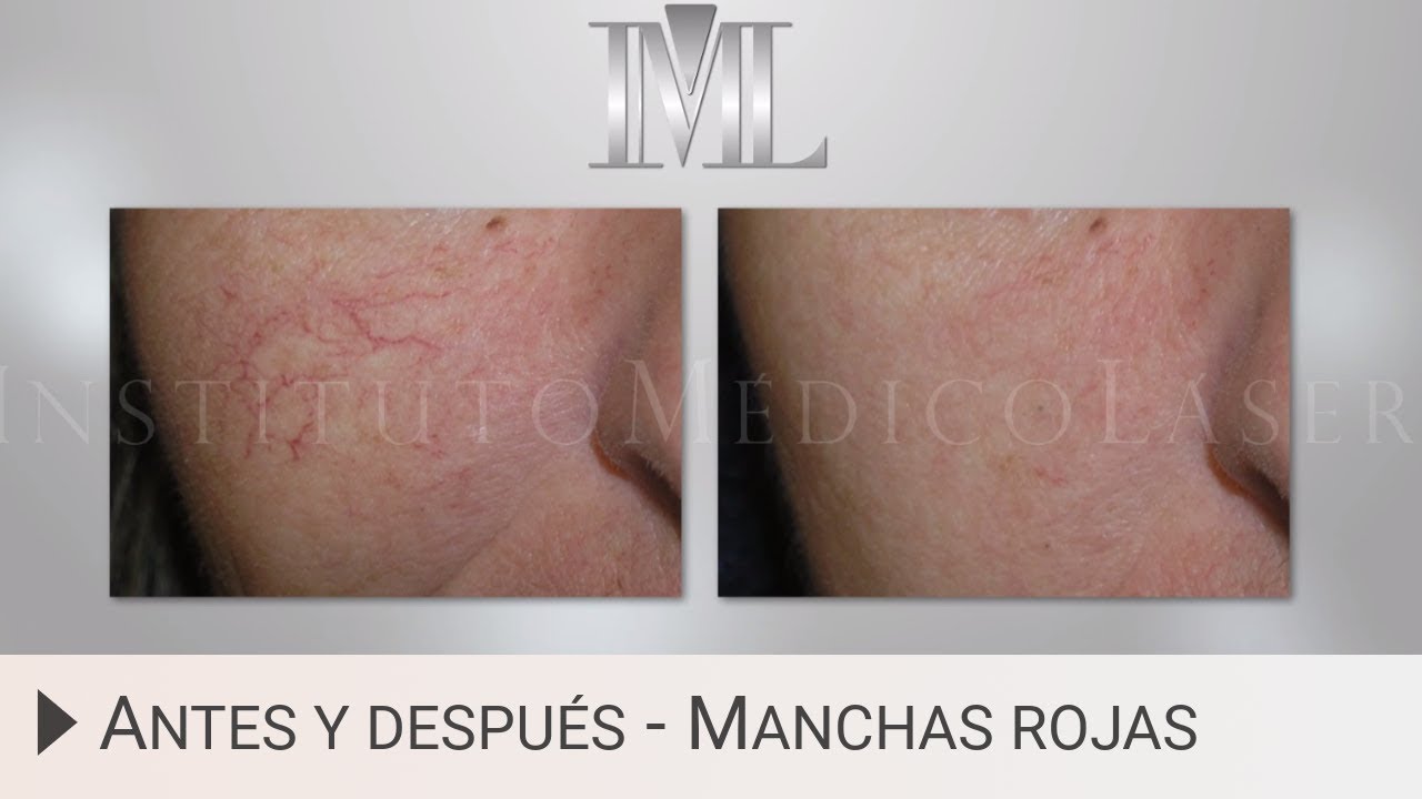 Antes y después. Eliminar manchas rojas en la piel
