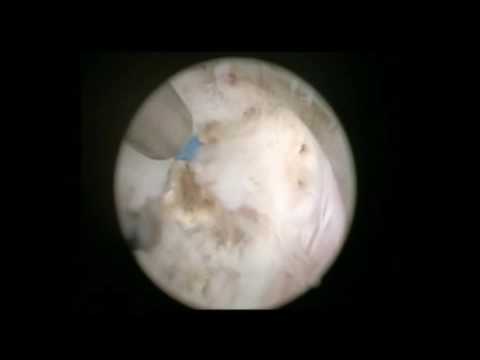 Uroflussometria BPH Annunci di massaggio prostatico