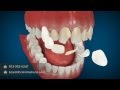 Cosmetic Dentistry Procedures - Dental Animation