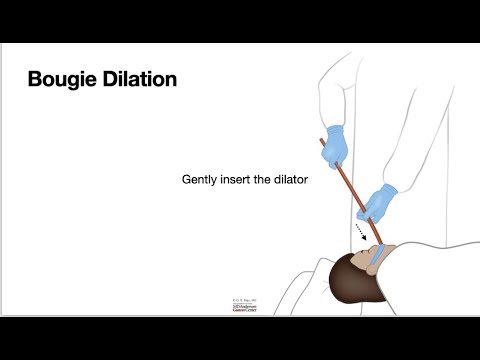 HCC 1475-38b-Bougie Dilator Without a Guidewire