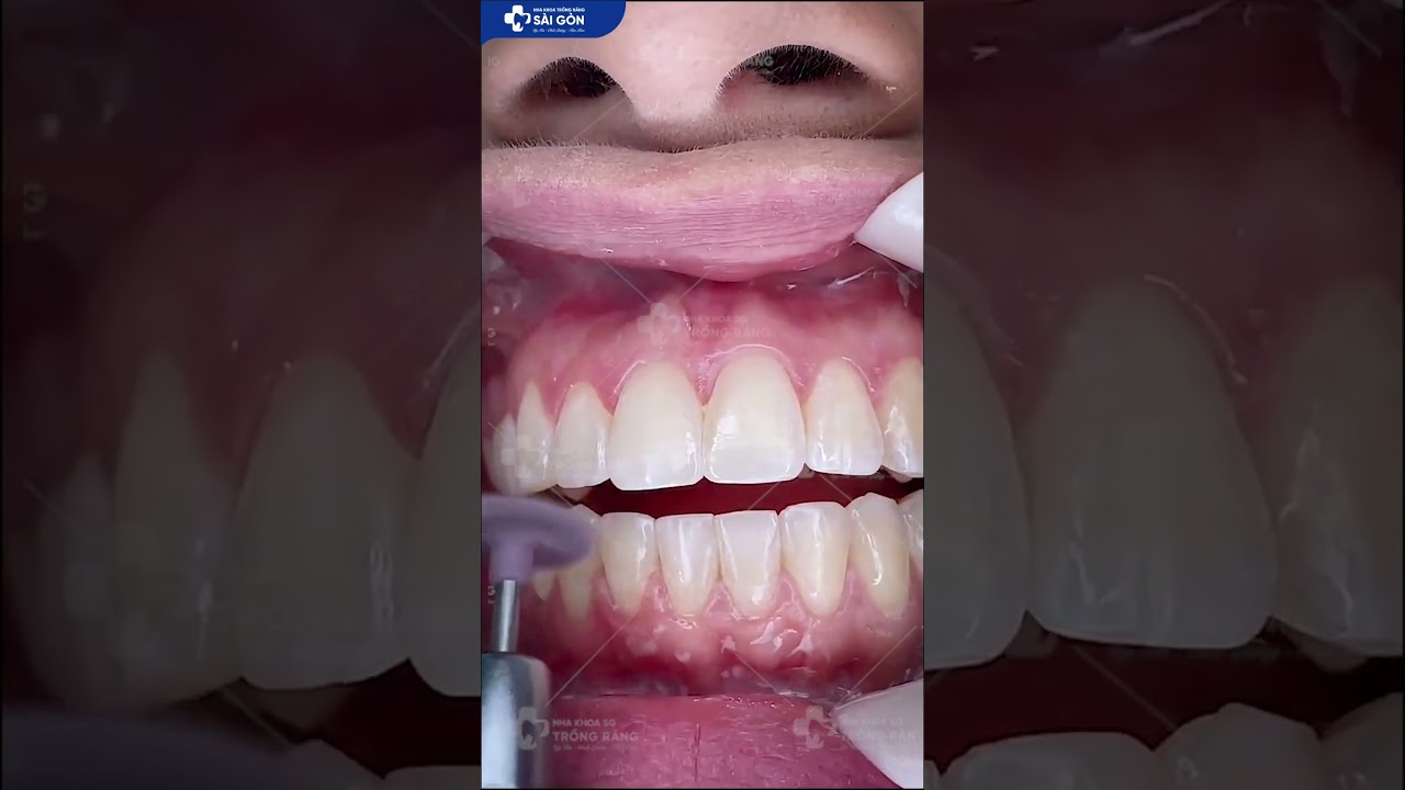 Tháo Niềng | Nha Khoa Trồng Răng Sài Gòn  #nhakhoatrongrangsaigon #thaonieng #niengrang
