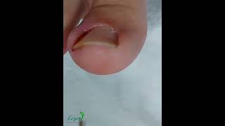 Vídeo de Unha Encravada, Unha Inflamada, Vídeos Satisfatórios