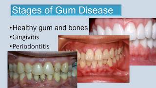 Stages of gum disease final edit 3