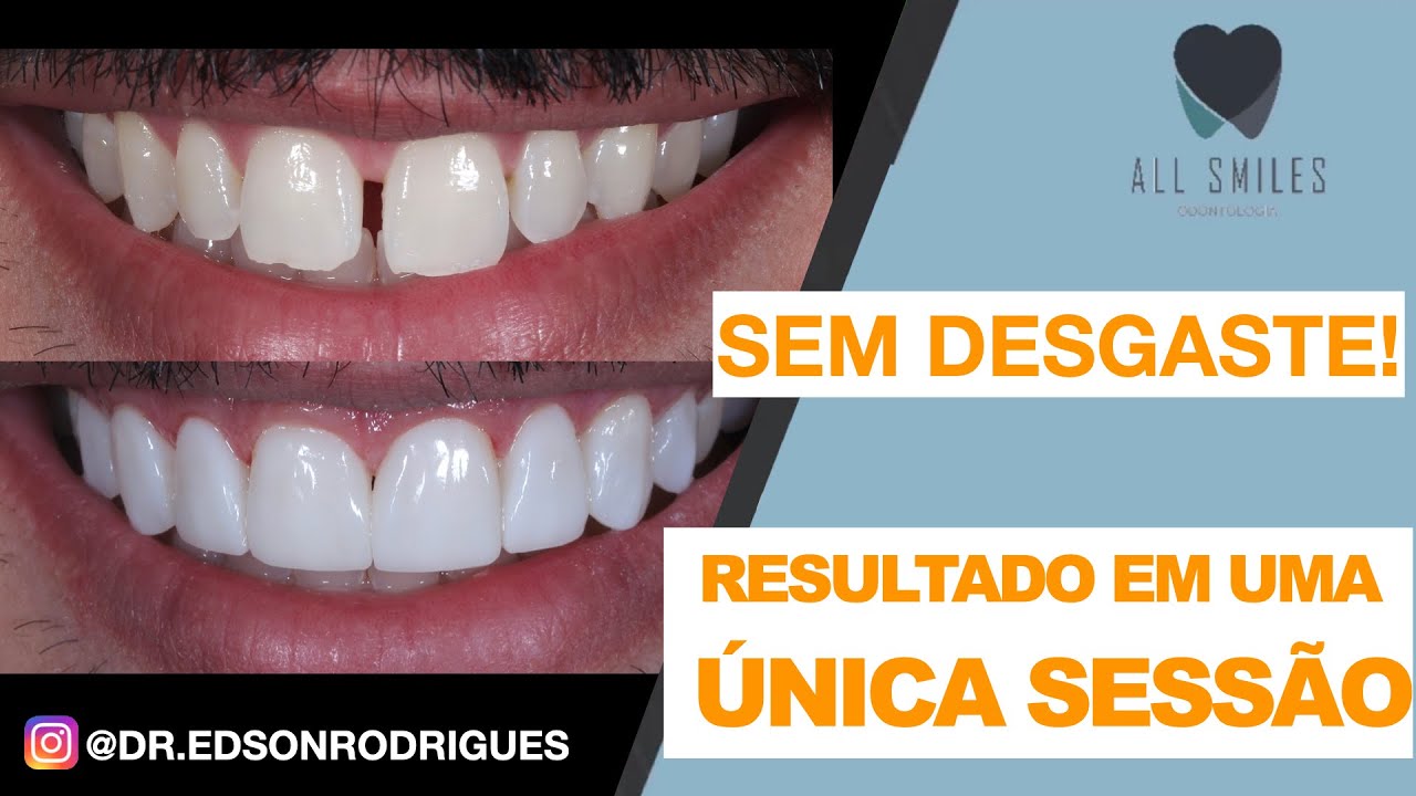 TRANSFORME SEU SORRISO!! Lentes de Resina explicadas passo a passo.