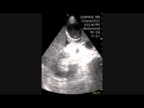 Cholecystitis