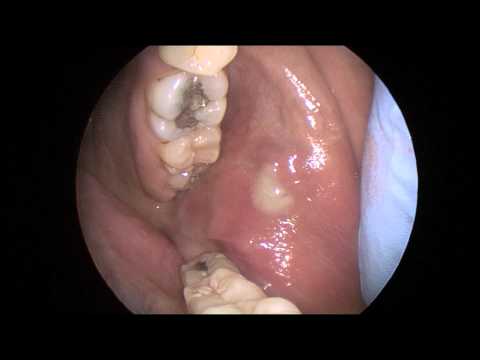 Acute Parotitis