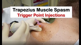 Trapezius Muscle Spasm Trigger Point Injection