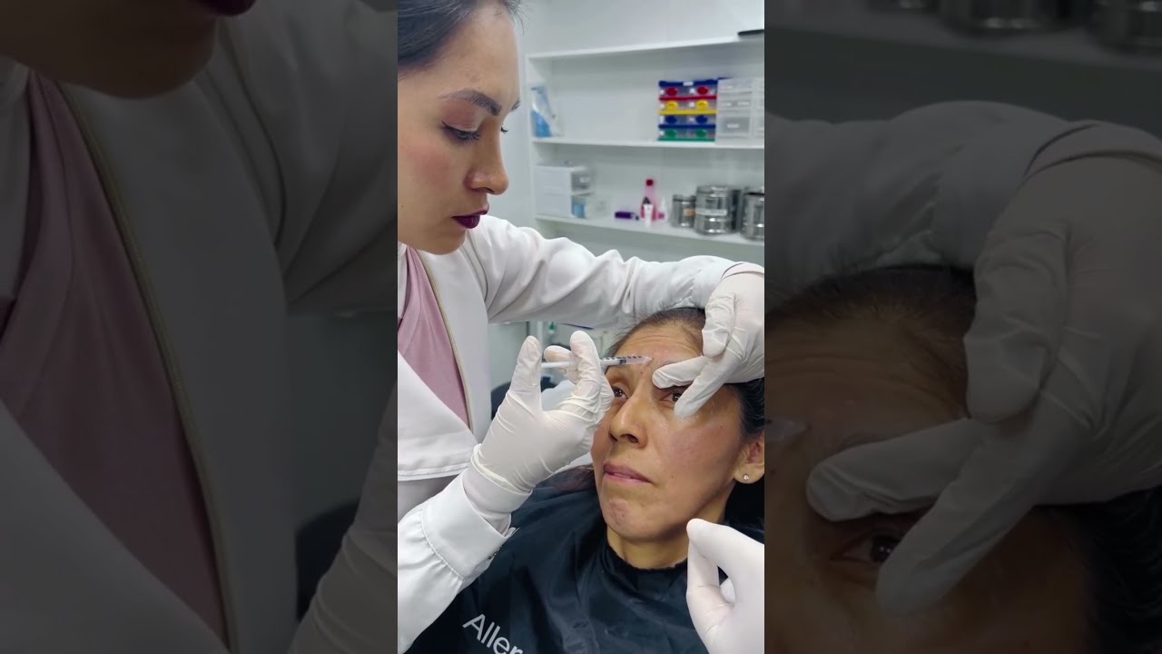 Toxina botulínica en rostro - BOTOX