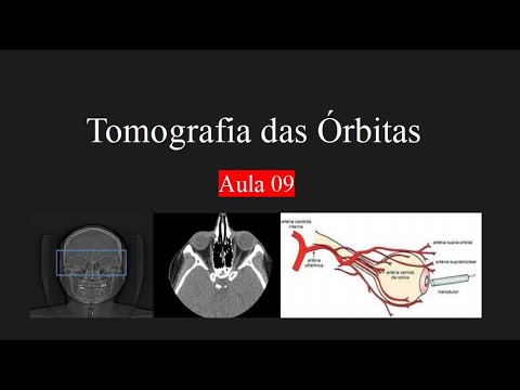 Curso de Tomografia c/contraste - Aula 9 (Órbitas)