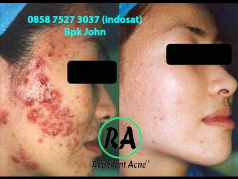 Impotensi disebabkan oleh masturbasi Bagaimana meningkatkan penis