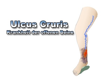 Die Behandlung disgidrotitscheskoj das Fussekzem Ob man die Tätowierungen machen kann wenn es die Schuppenflechte gibt