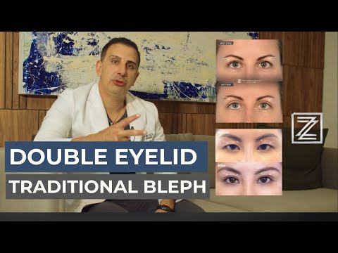 Double Eyelid Surgery vs Upper Blepharoplasty | Techniques, Scars, & Goals Explained