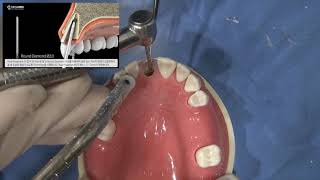 Root Membrane technique Hands-on