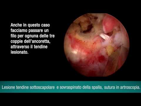 Che vi aiuterà con il mal di schiena nella regione lombare A destra codice ginocchio osteoartrite nel ICD 10