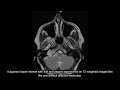 Glomus Jugulare MRI