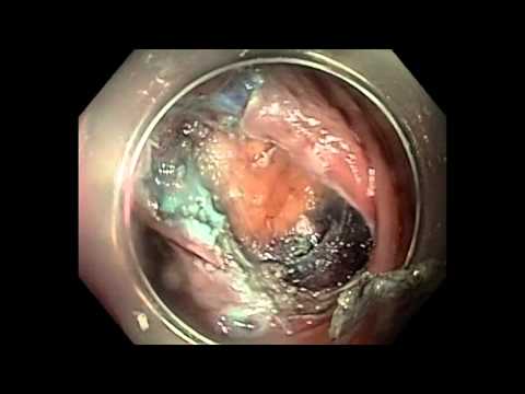 Endoscopic Full Thickness Resection In Recurrent Colonic Polyp