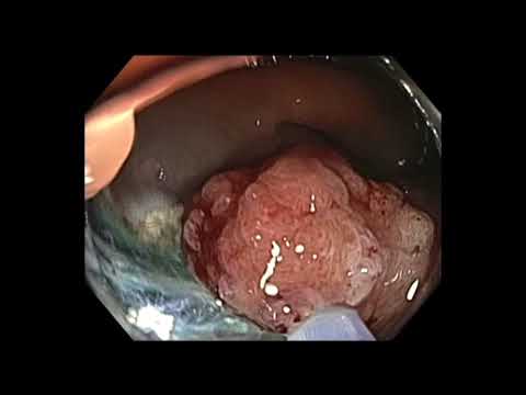 Colonoscopy: Large Cecal Polyp EMR 1.5 hours