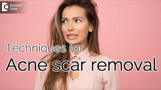 Is it possible to remove acne scars permanently? - Dr. Arti Priya R