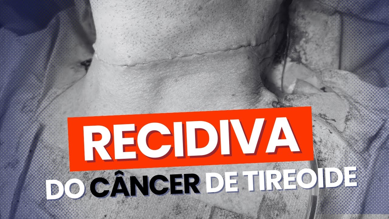 Tipos de Recidiva do Câncer de tireoide