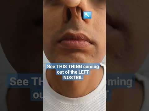 क्या आपको अपनी नाक में ऐसा तो नहीं दिखता 😨? #shorts #shortsvideo #viral #trending #shortsfeed